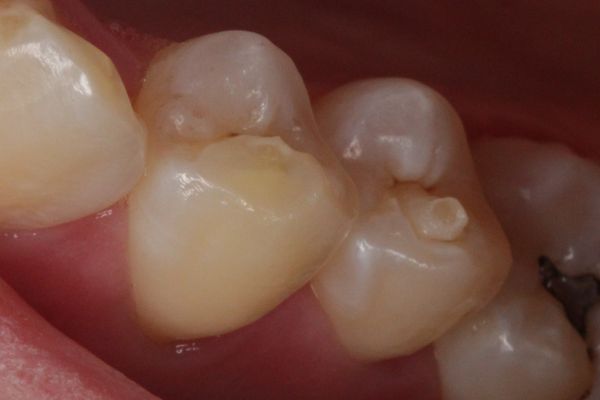 Núm Phụ Mặt Nhai – Hậu Quả Khôn Lường Mà Rất Ít Người Biết