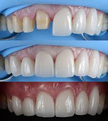 Các loại răng sứ trên thị trường: Làm sao để lựa chọn chính xác nhất?