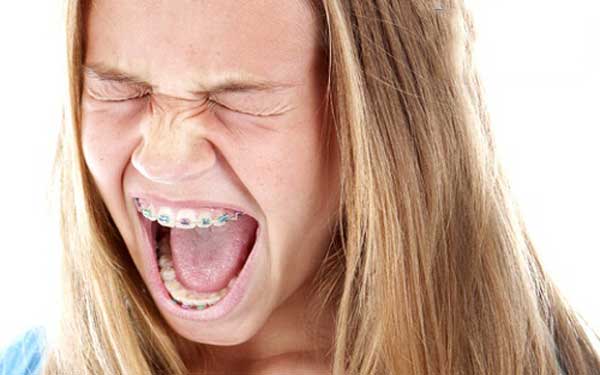 Niềng răng có đau không?