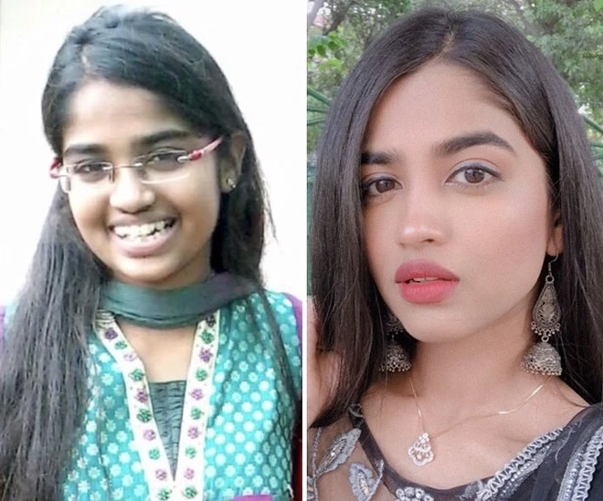 Niềng răng có làm thay đổi khuôn mặt không?