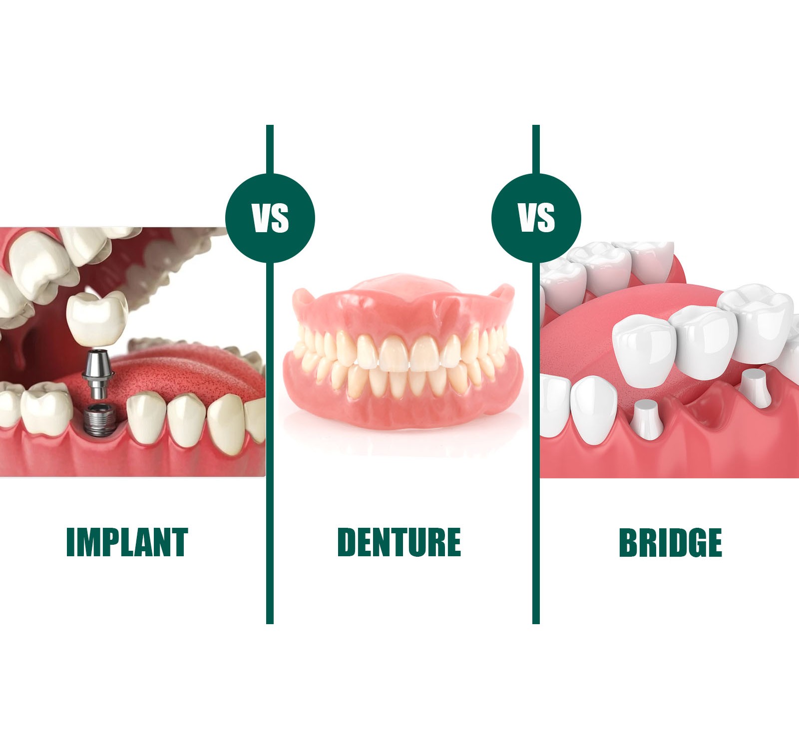 Ba Cách Trồng Lại Răng Đã Mất: Nên Chọn Cầu Răng, Hàm Tháo Lắp Hay Implant?