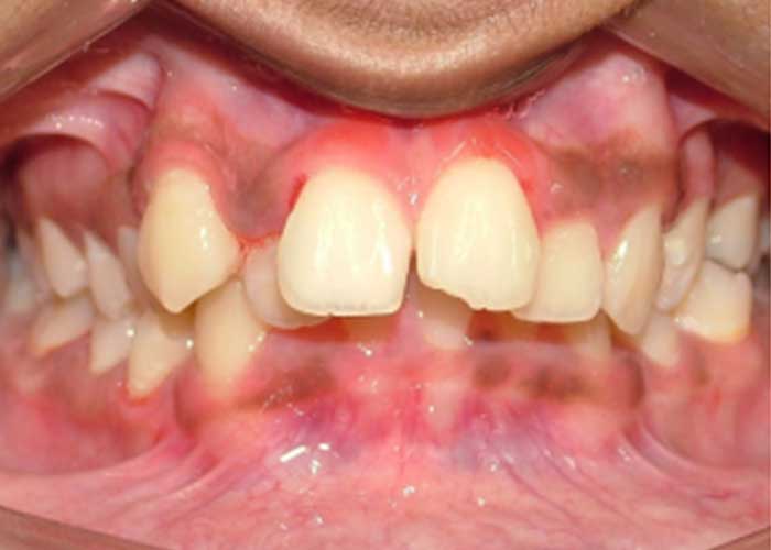 Vì Sao Răng Có Thể Bị Loe Sau Khi Sắp Đều?