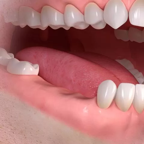 Mất Răng Số 7 Có Ảnh Hưởng Gì Không? Phục Hồi Bằng Cách Nào?