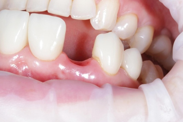 Mất Răng Cửa Phải Làm Sao? Cách Phục Hồi Đẹp Và Tự Nhiên