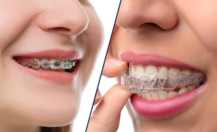 Niềng Mắc Cài Và Khay Trong Suốt Khác Nhau Như Thế Nào?