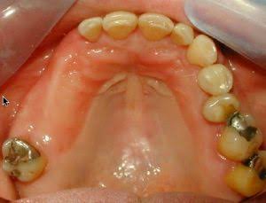 Mất Ba Hoặc Bốn Răng Liên Tiếp Nên Làm Cầu Răng Hay Implant?