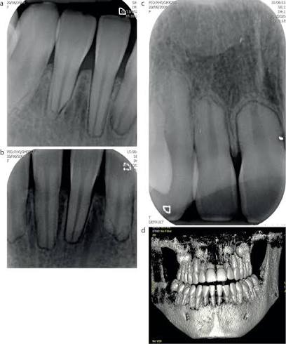 Niềng Răng Có Làm Tiêu Chân Răng Không? Câu trả lời dựa trên bằng chứng khoa học và sự trung thực của nha sĩ