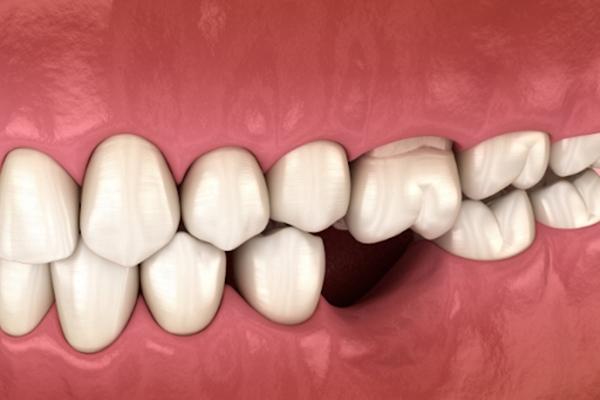 Mất Răng Số 6 Có Sao Không? Có Nhất Thiết Phải Trồng Lại?