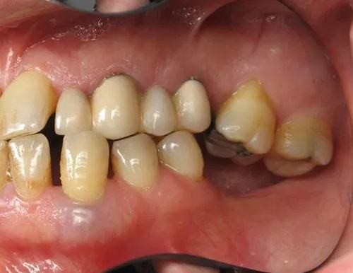 Mất Răng Trong Cùng Có Cần Trồng Implant Không?