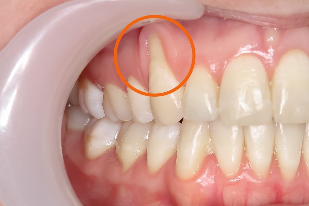 Niềng Răng Có Làm Tụt Lợi Không? Câu trả lời dựa trên bằng chứng khoa học
